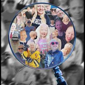 Eye of the Beholder by Casey Witte - Albinism (OCA2 Variant), Image 1.