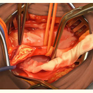Carotid Endarterectomy by Adyson McCullough