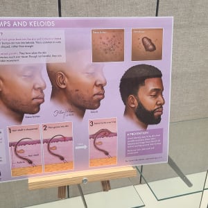 Razor Bumps and Keloids by Hillary Wilson