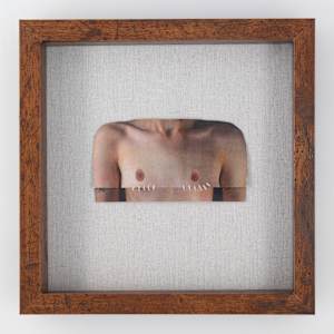 An Exercise in Prospective Double-Incision Top Surgery by Alexander Berning