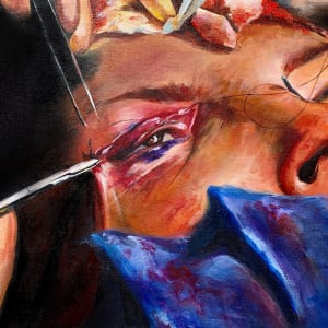 Double Eyelid Surgery by Jennifer Wu