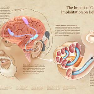 The Impact of Cochlear Implantation on Dementia by Chris Gralapp