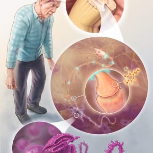 Parkinson's disease by Claudia Román