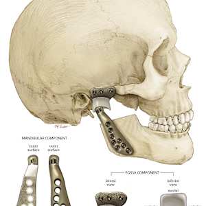 TMJ Prosthesis by Mary Kate Wright