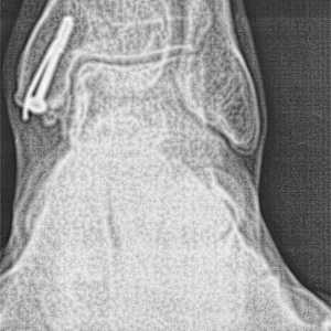 PLANTAR FLEXION>>>DORSIFLEXION by charles elwert